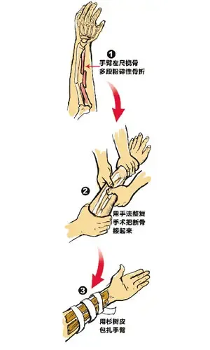 最美妈妈手臂整复成功坠楼女孩的爸爸跪谢